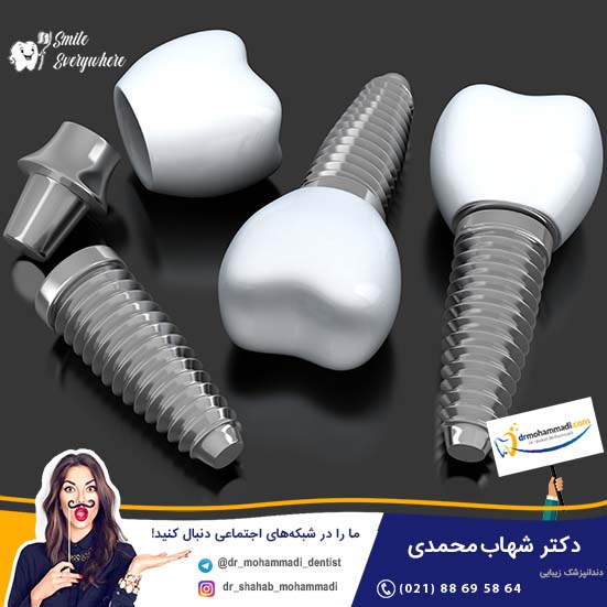 عمر مفید ایمپلنت دندان - کلینیک دندانپزشکی دکتر شهاب محمدی